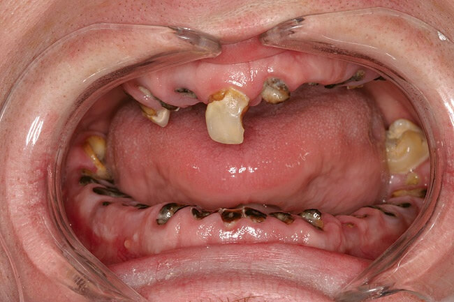 The Devastating Reality of “Meth Mouth”: Jennifer Ashenfelter’s Visible Struggle with Addiction